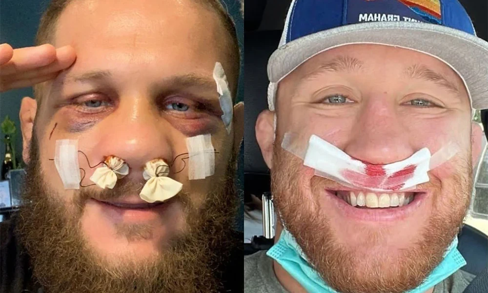 Rafael Fiziev calls out Justin Gaethje after they both underwent nose surgery (Credit: Instagram)