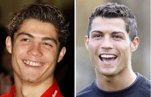 Cristiano Ronaldo's teeth transformation : Before and After