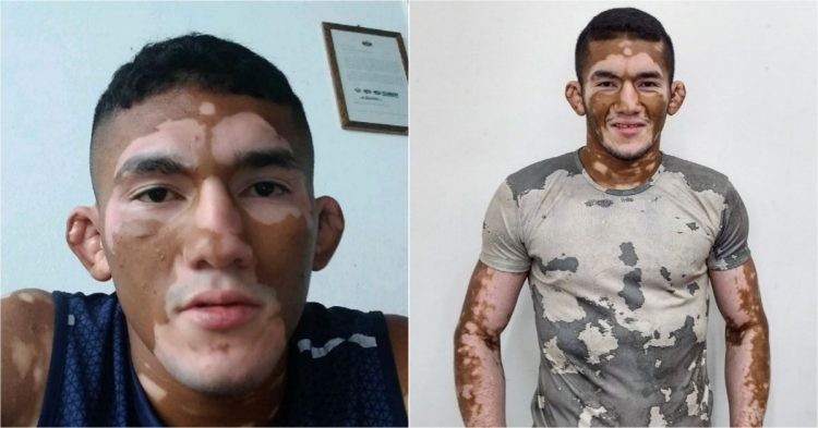 Melquizael Costa vitiligo