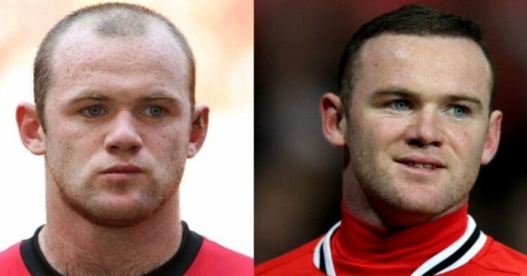 Wayne Rooney hair transplant before and after.