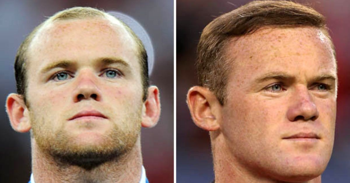 Closer look Rooney transplant