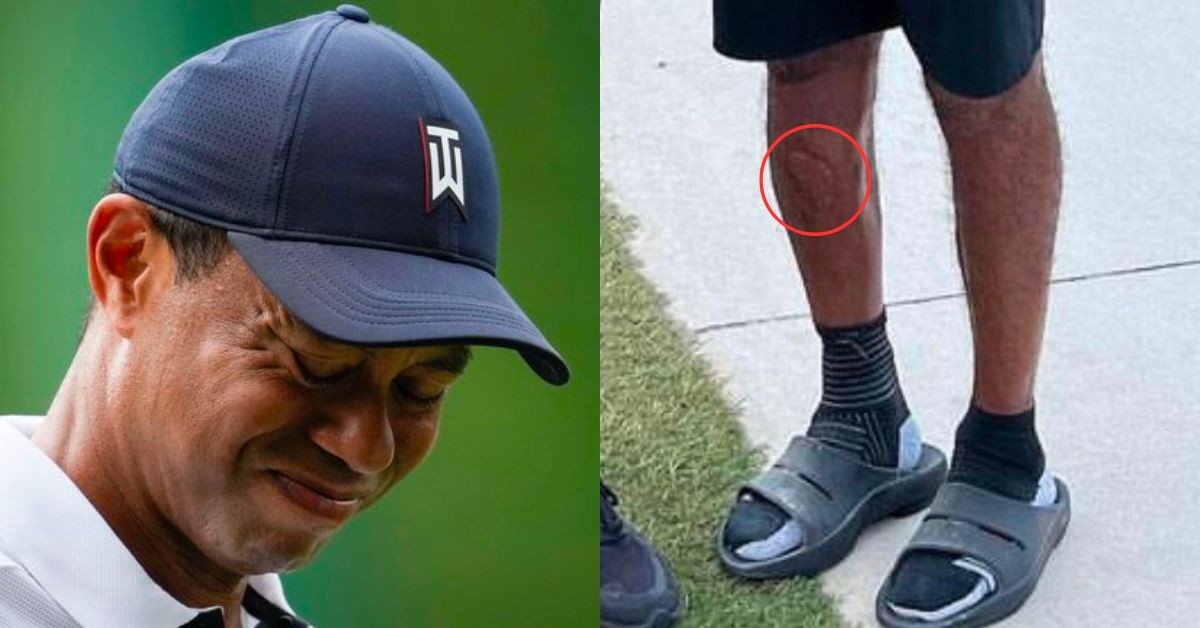 Tiger Woods' leg scar revealed