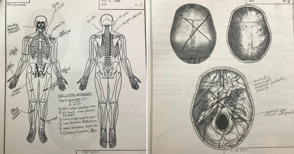 Gianna Bryant Autopsy Report Drawing What Caused Gigi's Horrific Death?