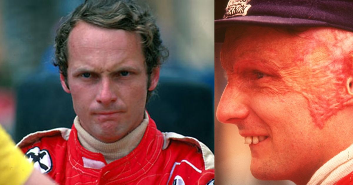 Niki Lauda before and after the accident at the 1976 German Grand Prix (Credits: Formula 1, CNN)