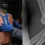 Istela Nunes broken elbow at UFC Vegas 77