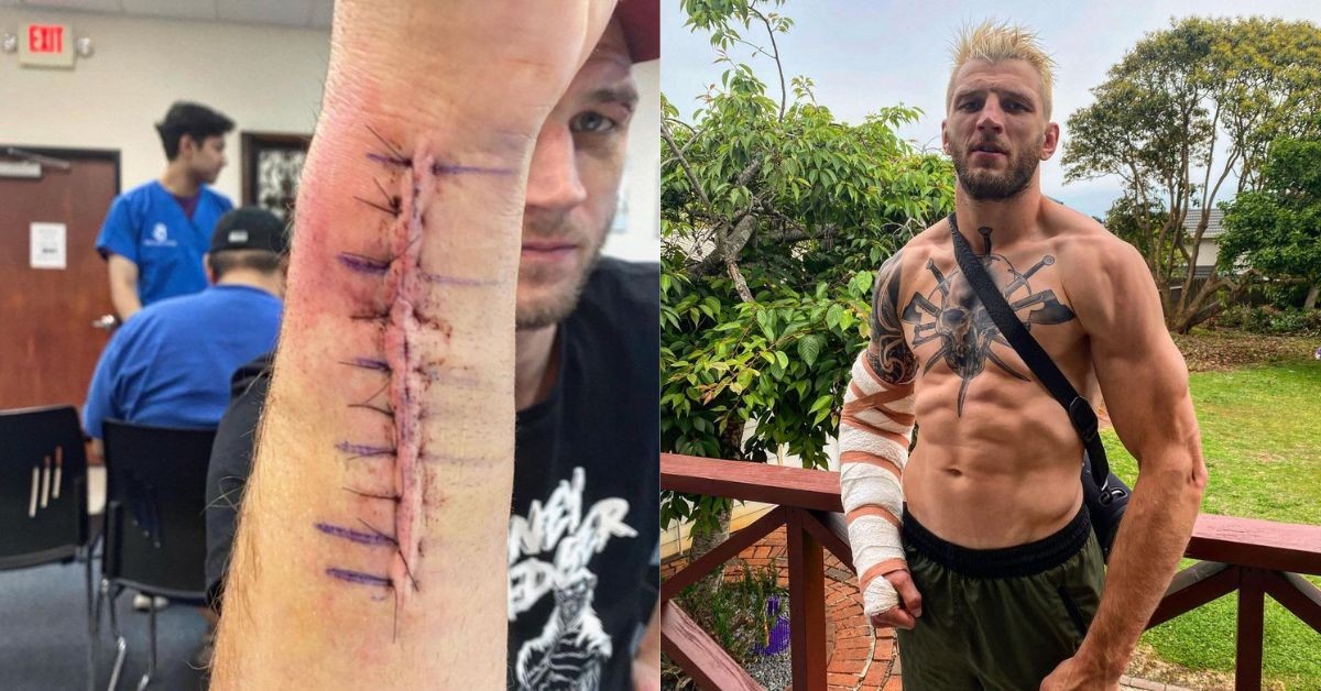Dan Hooker reveals his injured arm after surgery
