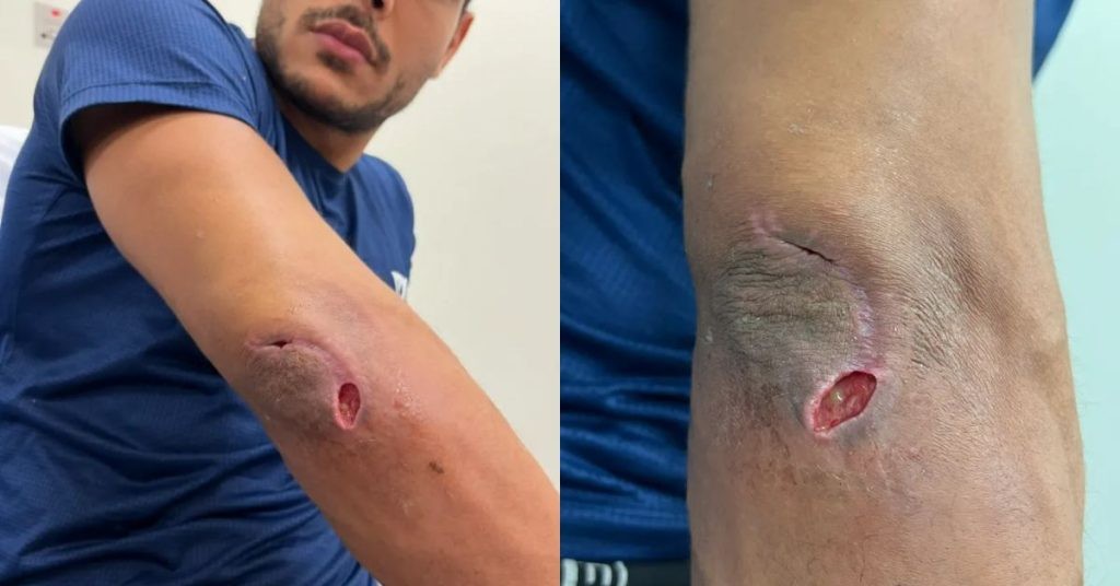 Paulo Costa's staph infection