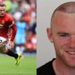 Wayne Rooney-hair transplant