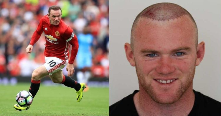 Wayne Rooney-hair transplant