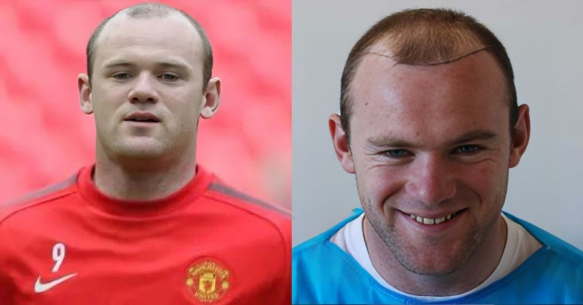 Wayne Rooney-transplant of hair