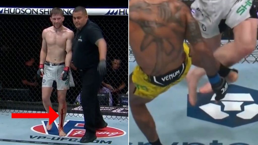 “The Doctor Didn’t Need to Be Digging His Damn Finger in the Cut”: Even UFC Fighters Are Terrified After Watching Jack Shore’s Nasty Leg Injury at UFC 301