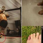 Conor McGregor suffers pinky toe fracture during training